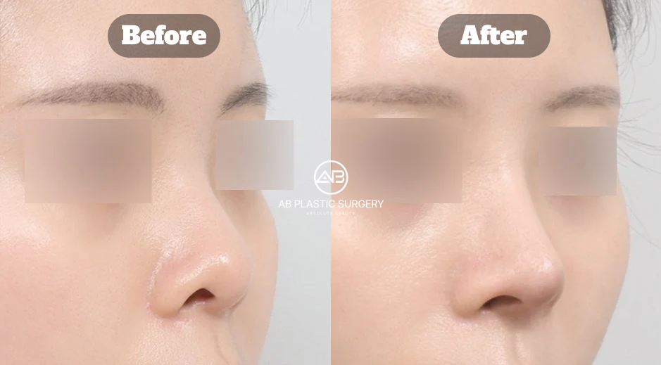 Before and After Results of Revision Rhinoplasty at AB Plastic Surgery Korea for Short Nose and Structural Nose Repair