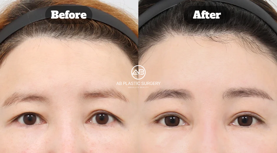 AB Plastic Surgery Korea Endotine Brow Lift and Non-incisional Eye Correction Results