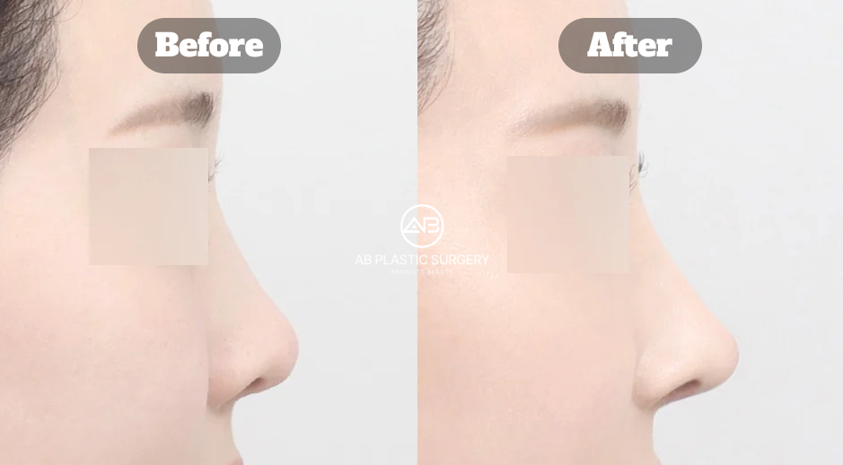 Before and After Results of Revision Rhinoplasty at AB Plastic Surgery Korea Using Autologous Cartilage for Bulbous Nose Repair