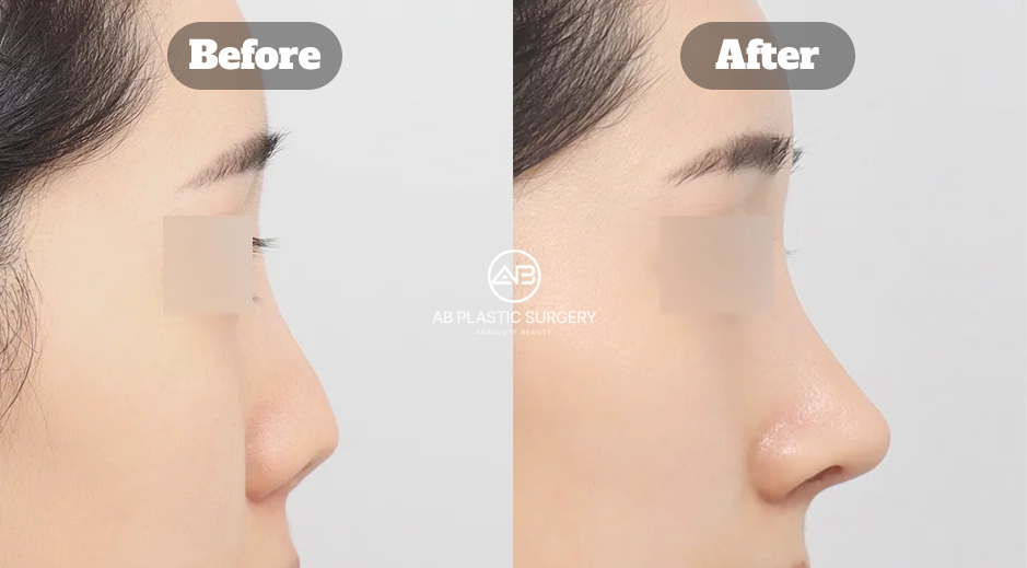 Before and After Results of Revision Rhinoplasty at AB Plastic Surgery Korea Using Cartilage Grafting for Short Nose Correction