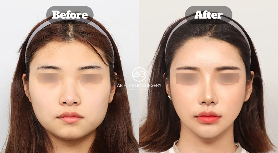 Three-Month Before and After Results of Chin Augmentation Surgery at AB Plastic Surgery Korea With Improved Facial Proportion