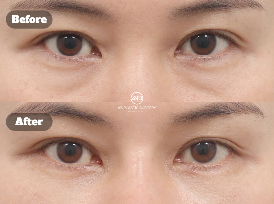 Under-Eye Fat Repositioning Results for Smoother Under-Eye Contours