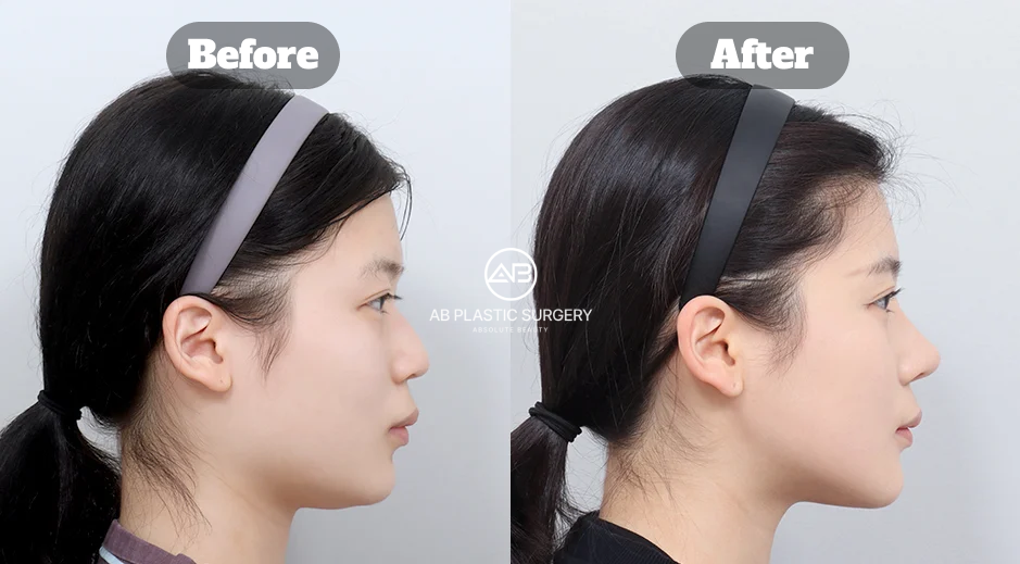 Side Profile Before and After Results of Facial Contouring and Rhinoplasty at AB Plastic Surgery Korea Showing Surgical Treatment Areas