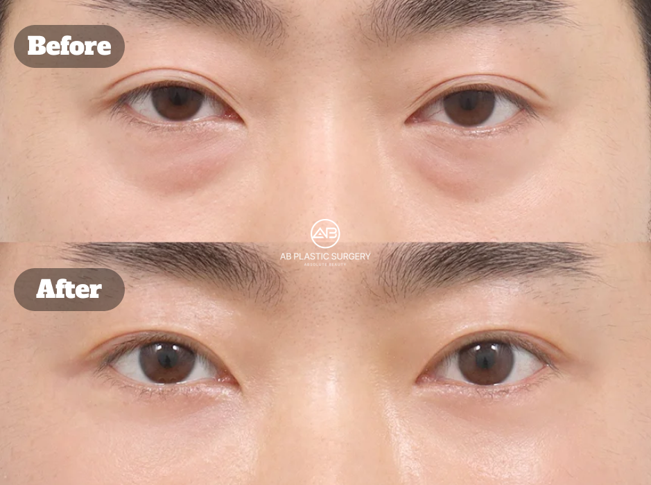 Seven-Day Recovery After Under-Eye Fat Repositioning for Eye Bags
