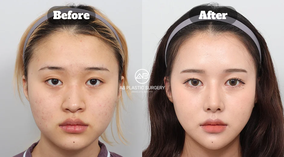 Four-Month Before and After Results of Chin Tip Surgery at AB Plastic Surgery Korea Showing Balanced Lower Face Contour