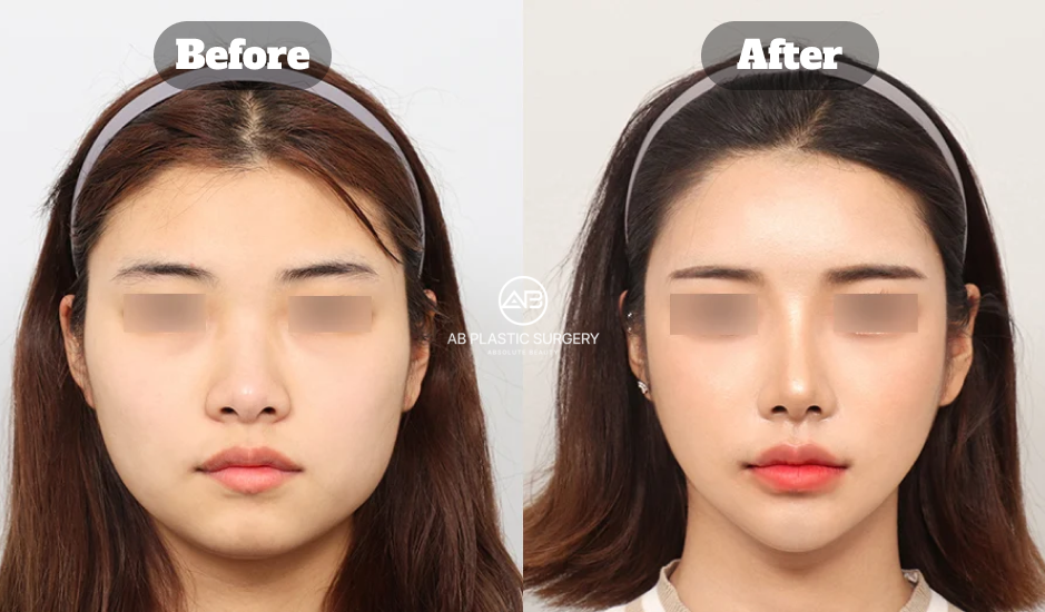 Under-Eye Fat Repositioning for Eye Bags and Tear Trough Correction Before and After