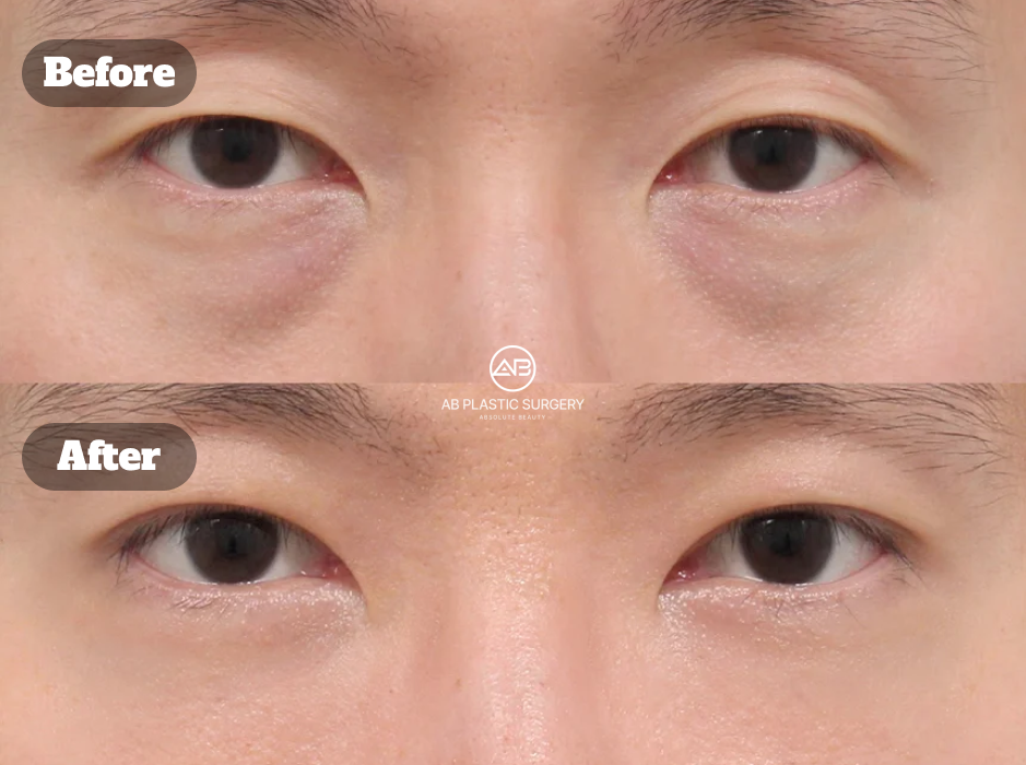 Under-Eye Fat Repositioning Recovery Progress in a Male Patient at 7 Days