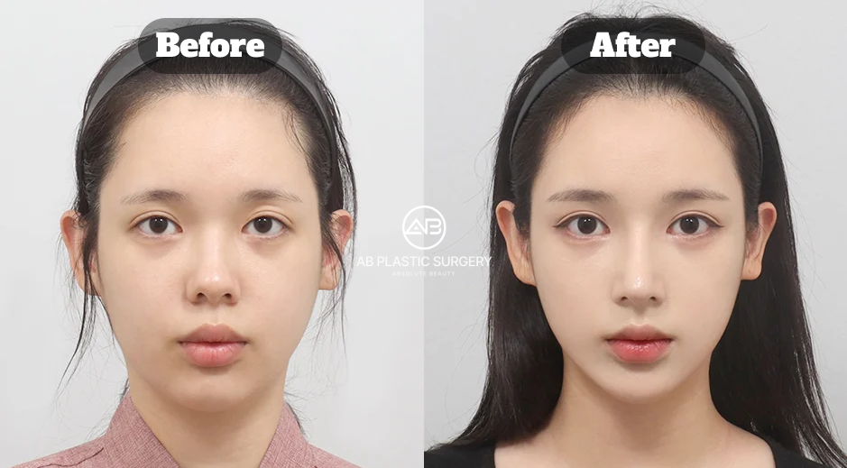 Three-Month Before and After Results of Facial Contouring, Rhinoplasty, and Eye Surgery Performed at AB Plastic Surgery Korea