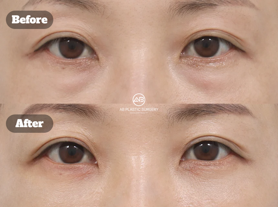 Early Recovery Results Following Under-Eye Fat Repositioning at 6 Days