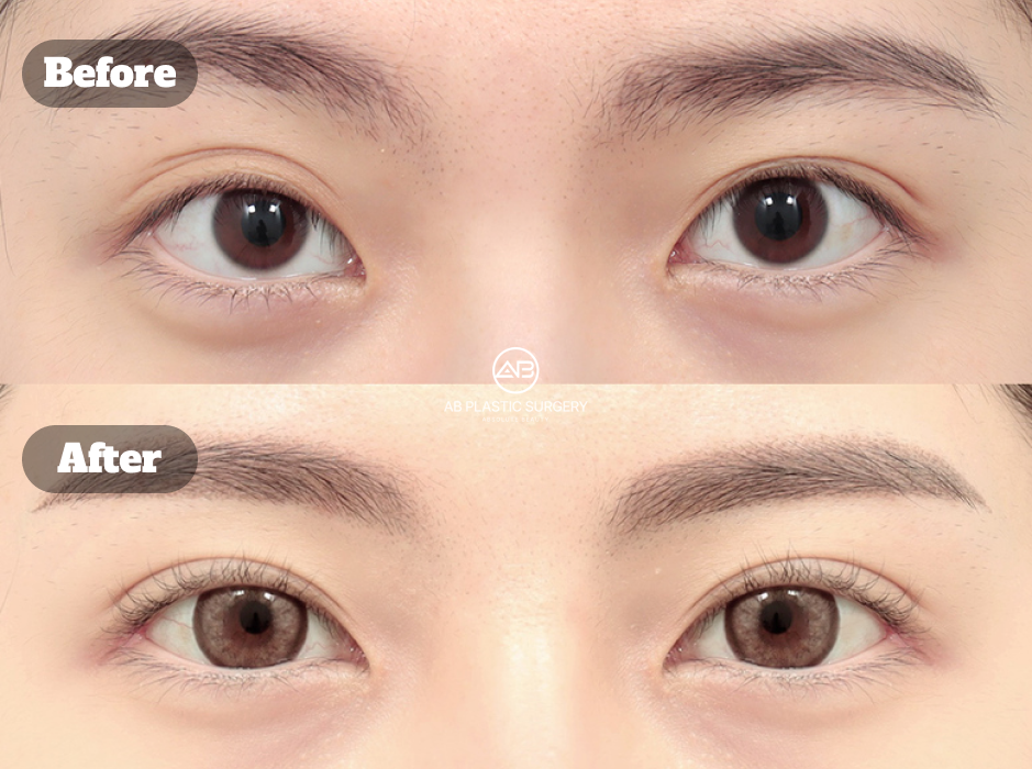 Before and After Photos of Non Incisional Ptosis Correction and Lateral Canthoplasty at AB Plastic Surgery Korea