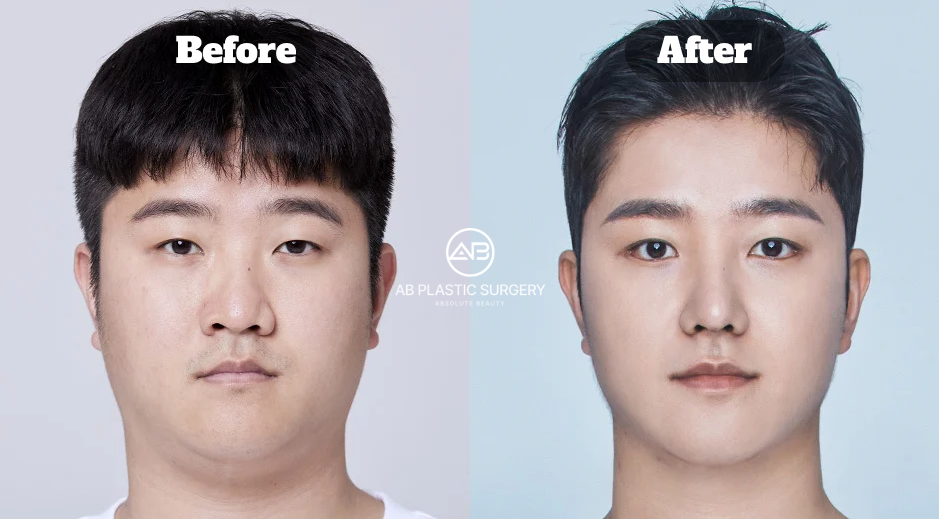 Two-Month Before and After Results of Male Genioplasty for Chin Asymmetry Correction at AB Plastic Surgery Korea
