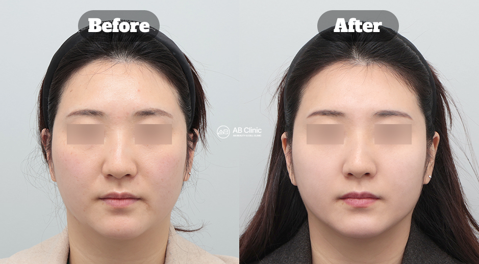One-Month Before and After Results of Stem Cell Facial Rejuvenation at AB Plastic Surgery Korea Showing Improved Skin Quality, Facial Radiance, and Overall Skin Texture