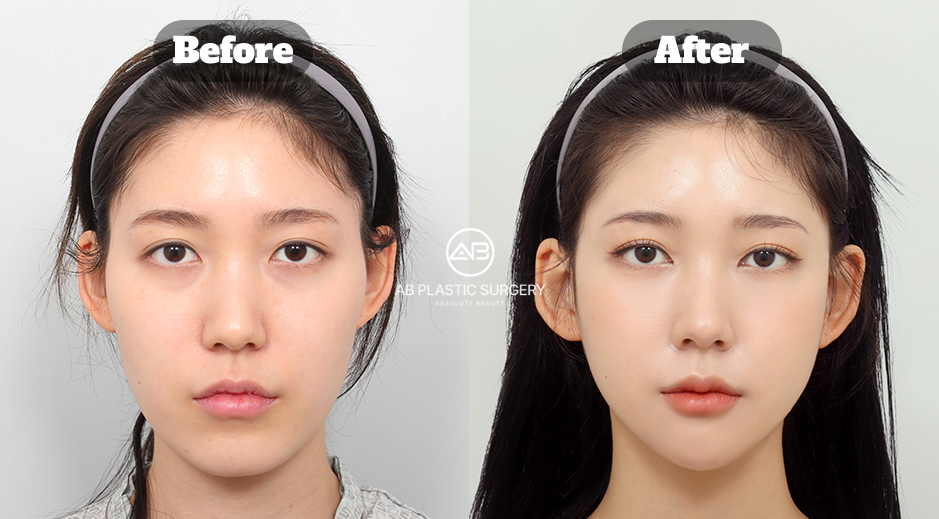 Three-Month Before and After Results of Square Jaw, Zygoma Reduction, and Genioplasty at AB Plastic Surgery Korea
