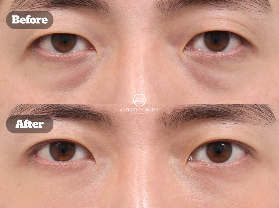Male Eye Bag Correction with Under-Eye Fat Repositioning Before and After