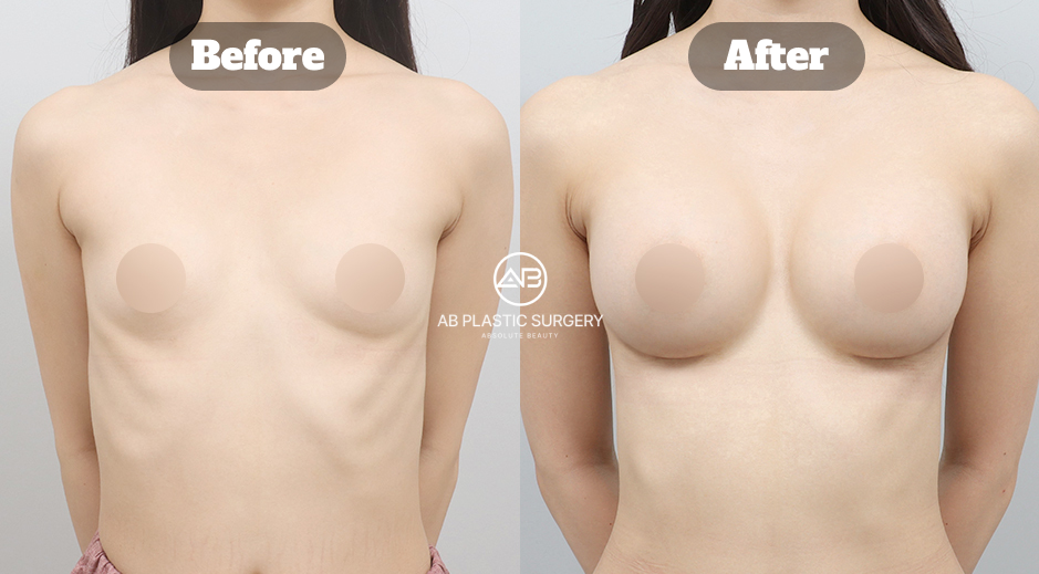Two-Month Before and After Results of Mentor Breast Augmentation at AB Plastic Surgery Korea