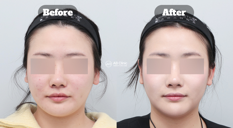 Before and After Results of Combined Ultherapy, Thermage, and Rejuran Treatment at AB Plastic Surgery Korea Showing Improved Facial Firmness, Skin Texture, and Overall Rejuvenation