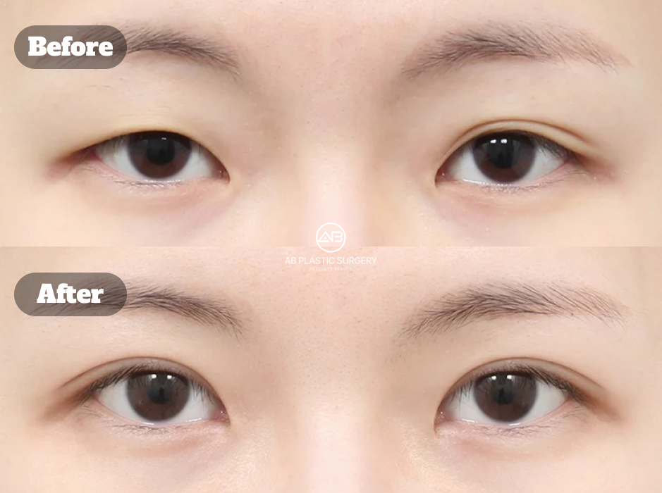 Before-and-after comparison showing the one-month result of incisional ptosis correction combined with revision eyelid surgery.