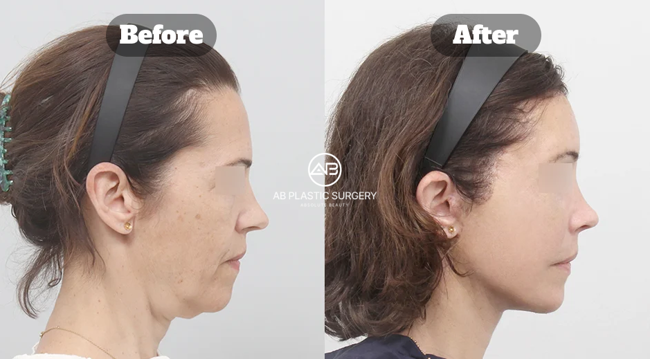Before-and-after comparison showing neck lift and platysmaplasty results for improved double chin and jawline definition.