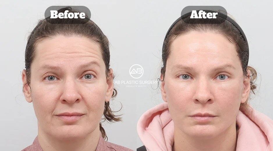 Front-view before-and-after comparison showing facial contour changes following a full SMAS facelift at AB Plastic Surgery Korea.