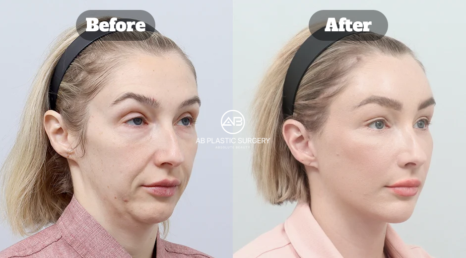Oblique-view comparison showing results after a full SMAS facelift and bone-tunneling forehead lift at AB Plastic Surgery Korea.