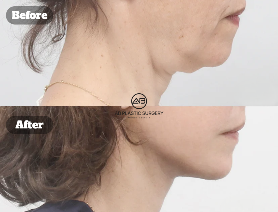 Before-and-after side-profile comparison showing neck lift results 12 days after surgery.