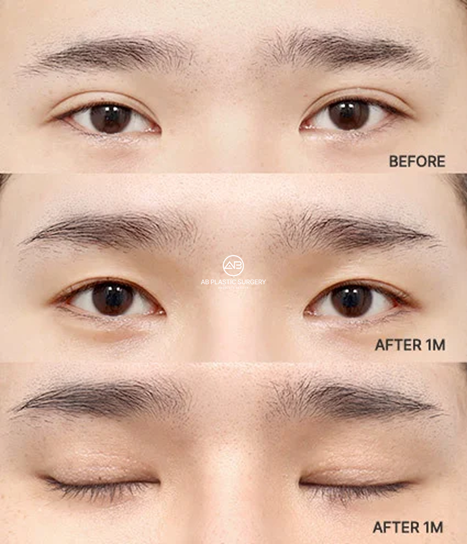 Before-and-after images showing revision double eyelid surgery results with the eyes open and closed one month after surgery.