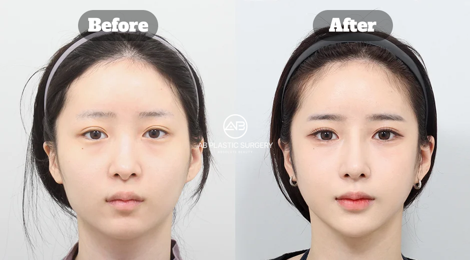 Before-and-after comparison showing square jaw and cheekbone reduction results two months after facial contouring surgery.