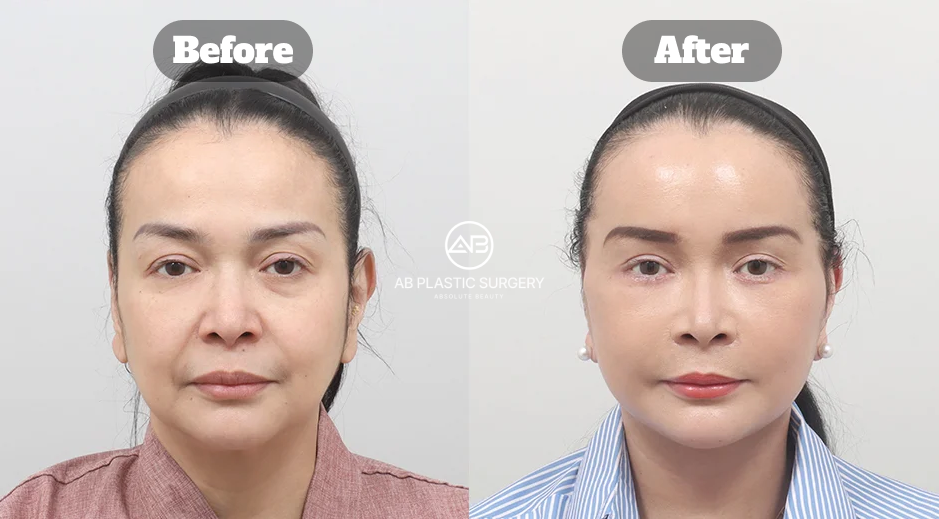 Front-view before-and-after comparison showing facial and neck contour changes after a full SMAS facelift with neck lift.