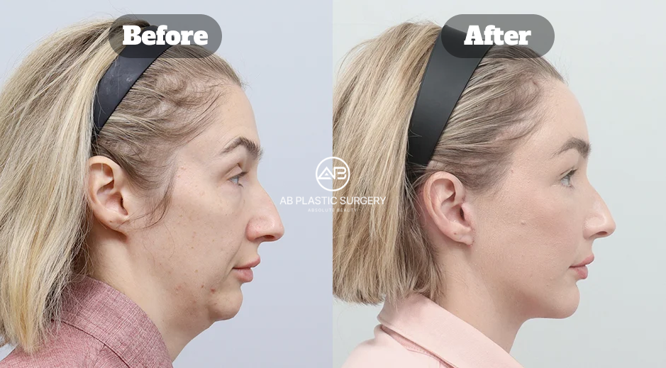 Profile before-and-after comparison showing jawline and forehead changes after a full SMAS facelift with bone-tunneling forehead lift.