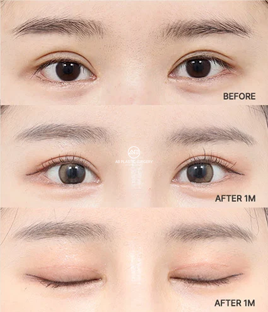Clinical comparison showing a more defined and symmetrical eyelid crease one month after revision double eyelid surgery.