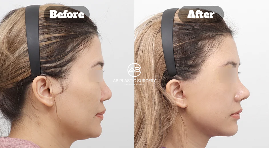 Before-and-after comparison showing facial and neck contour changes following a neck lift with stem cell treatment.