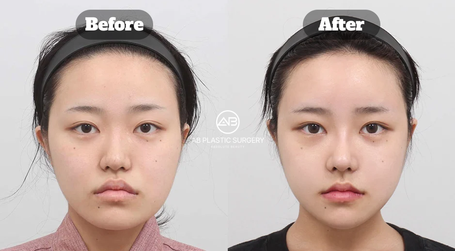Before-and-after comparison showing square jaw, cheekbone, and chin reduction results two months after three-point facial contouring.