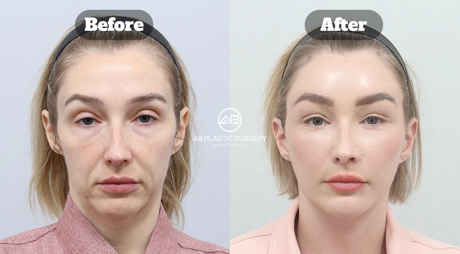 Front-view results after a full SMAS facelift, forehead lift, neck lift, submental muscle tightening, and facial fat grafting.