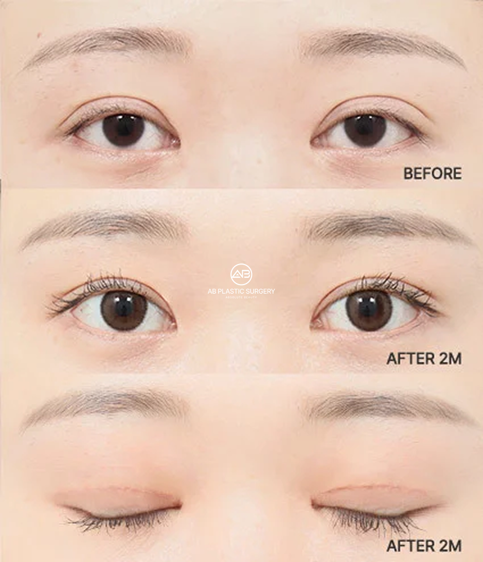 Before-and-after comparison showing eyelid crease and eye-opening changes two months after revision eyelid surgery.