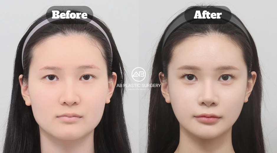 Long-term before-and-after comparison showing square jaw, cheekbone, and chin reduction results two years and nine months after surgery.