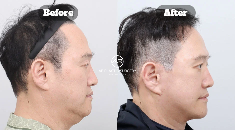 Before-and-after side-profile comparison showing male neck lift surgery results with a more defined jawline.