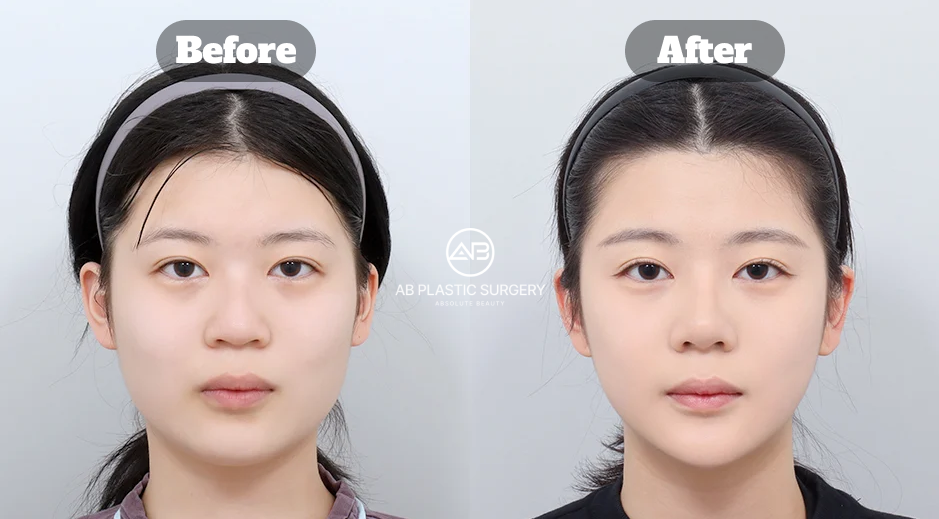 Before-and-after comparison showing a slimmer facial contour four months after square jaw, cheekbone, and chin reduction surgery.