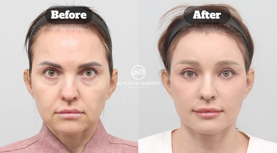 Front-view before-and-after comparison following a full SMAS facelift combined with an incisional forehead lift.