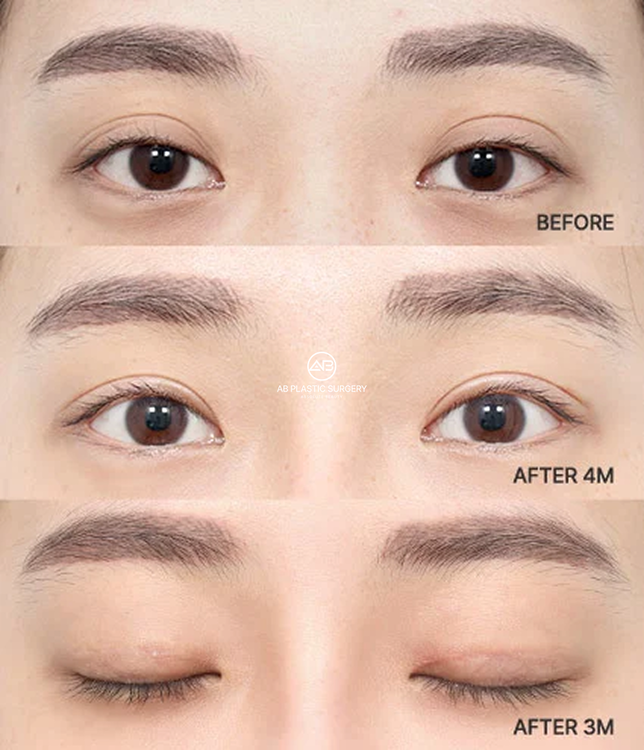 Before-and-after comparison showing eyelid crease and eye-opening changes two months after revision eyelid surgery.