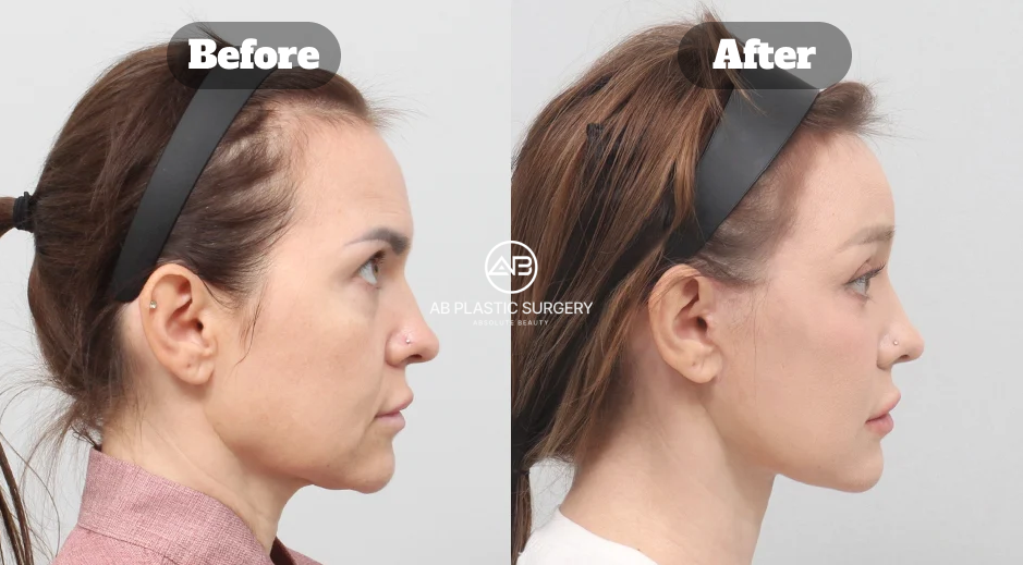 Front-view comparison showing results after a full SMAS facelift, forehead reduction lift, and neck lift at AB Plastic Surgery Korea.
