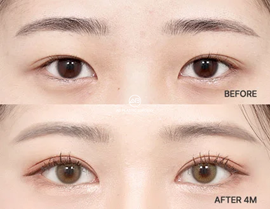 Before-and-after comparison showing balanced double eyelid creases four months after revision eyelid surgery in Korea.