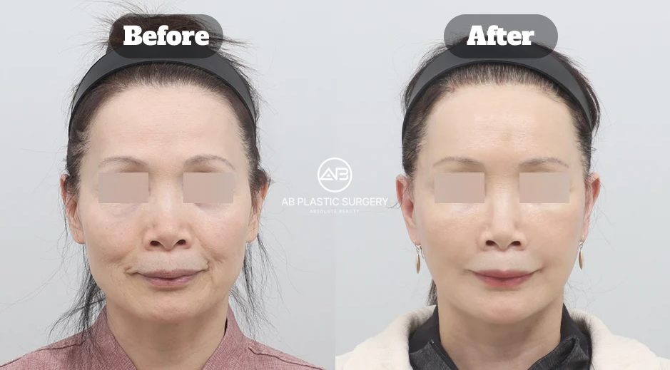 Front-view before-and-after comparison showing early full SMAS facelift results 10 days after surgery.