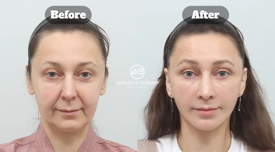 Before-and-after comparison showing combined full SMAS facelift and neck lift results across the lower face and neck.