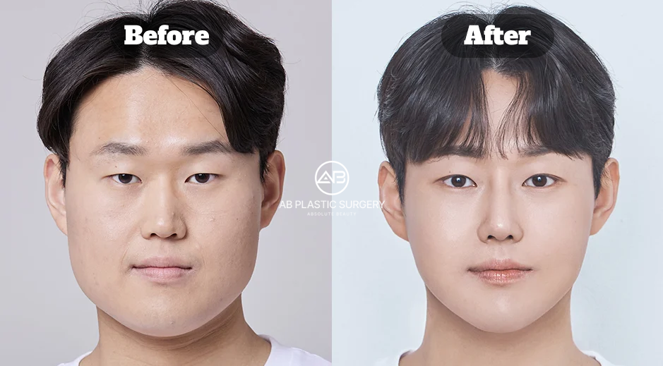 Before-and-after comparison of a male patient three months after square jaw and chin reduction surgery in Korea.