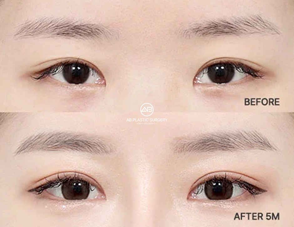 Before-and-after comparison showing a natural and symmetrical eyelid crease five months after revision double eyelid surgery.