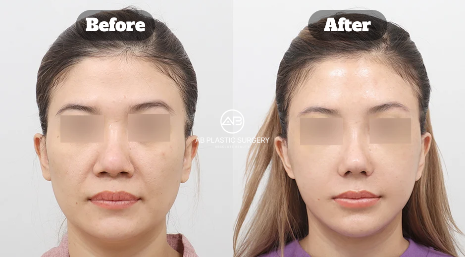 Front-view before-and-after comparison showing facial appearance following stem cell treatment at AB Plastic Surgery Korea.