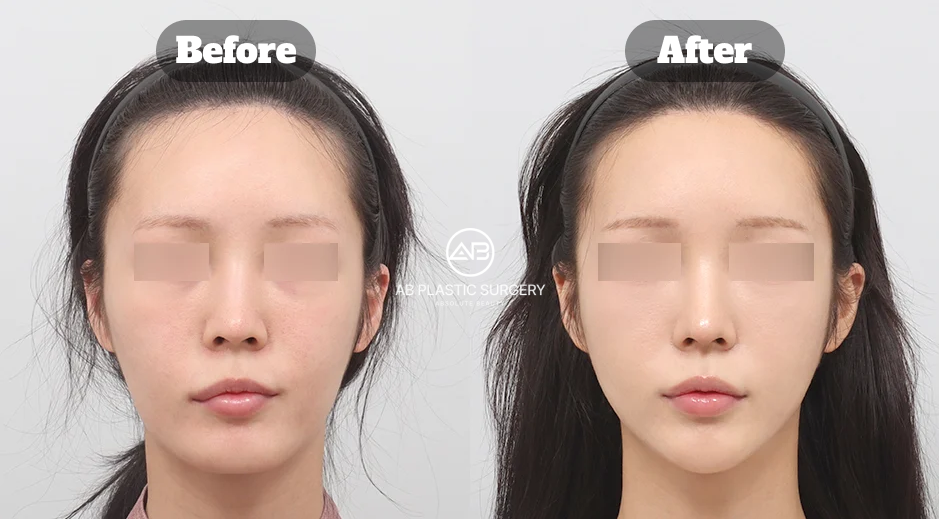 Before-and-after comparison showing a refined lower face six months after square jaw reduction and chin contouring surgery.