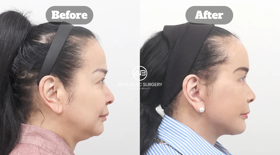 Before-and-after side-profile comparison showing SMAS facelift, neck lift, and double chin liposuction results.