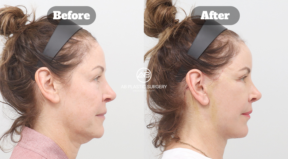 Before-and-after profile comparison showing combined facelift, neck lift, and platysma repair results for lower-face rejuvenation.