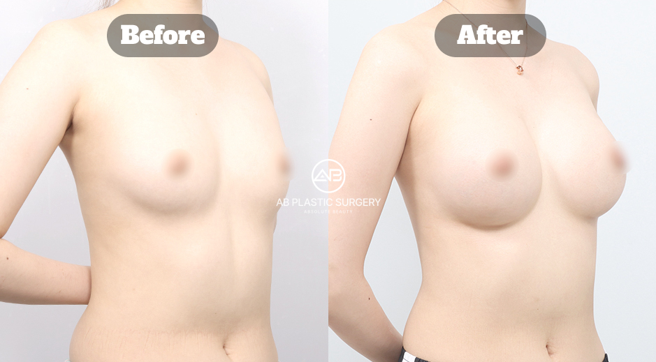 Before and After Motiva Breast Augmentation for Sagging Breasts Showing Fuller Volume and Enhanced Breast Shape